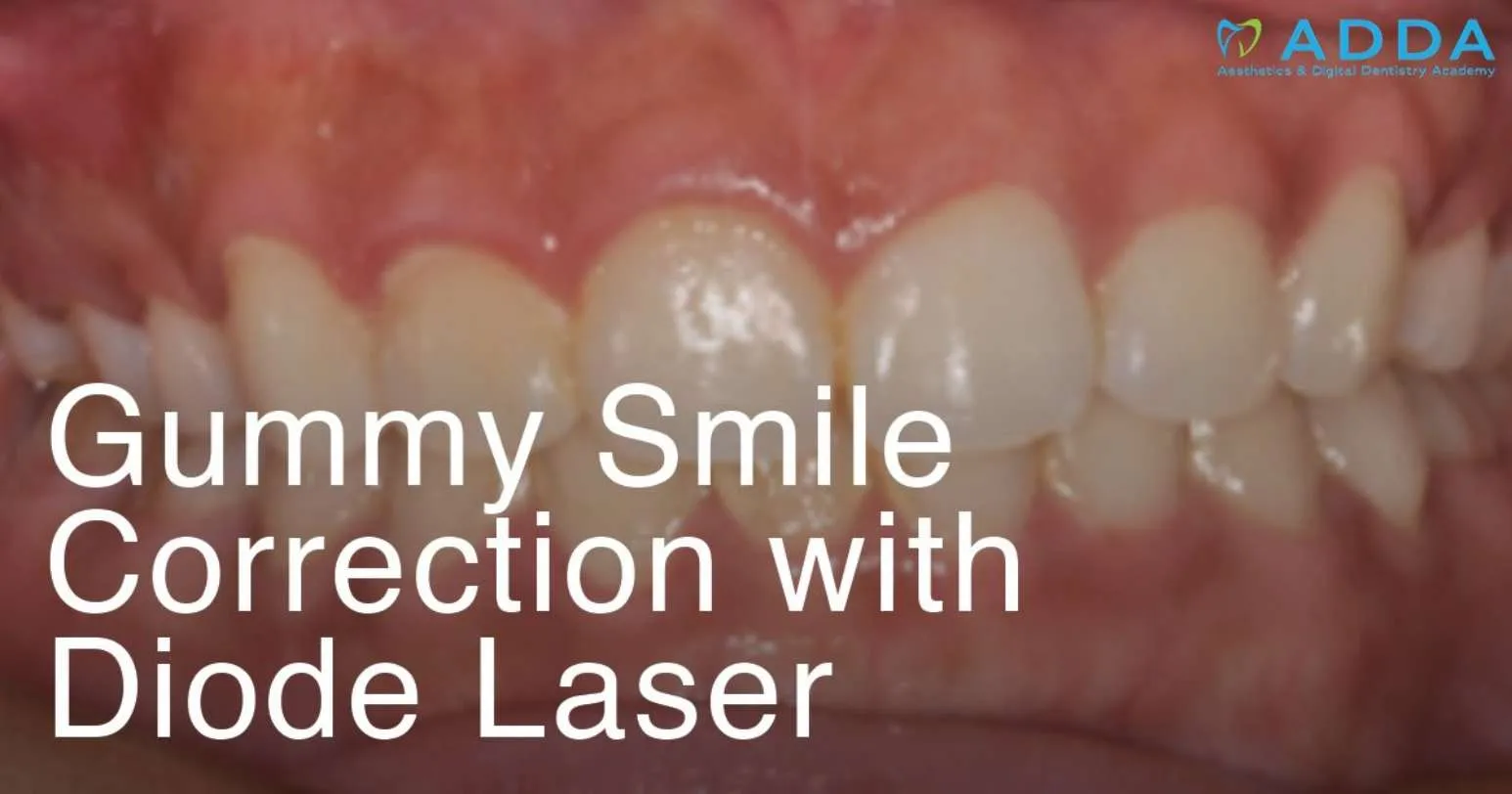 Gummy Smile Correction With Diode Laser