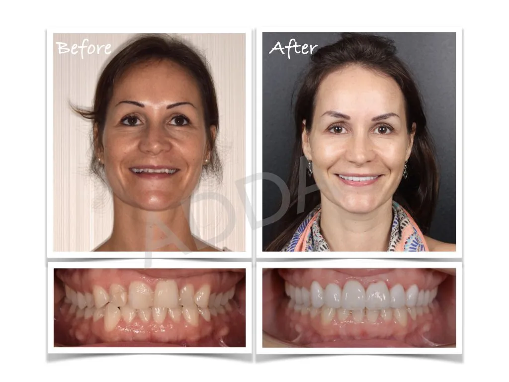 Smile Makeover Case Study 1: Porcelain Veneers