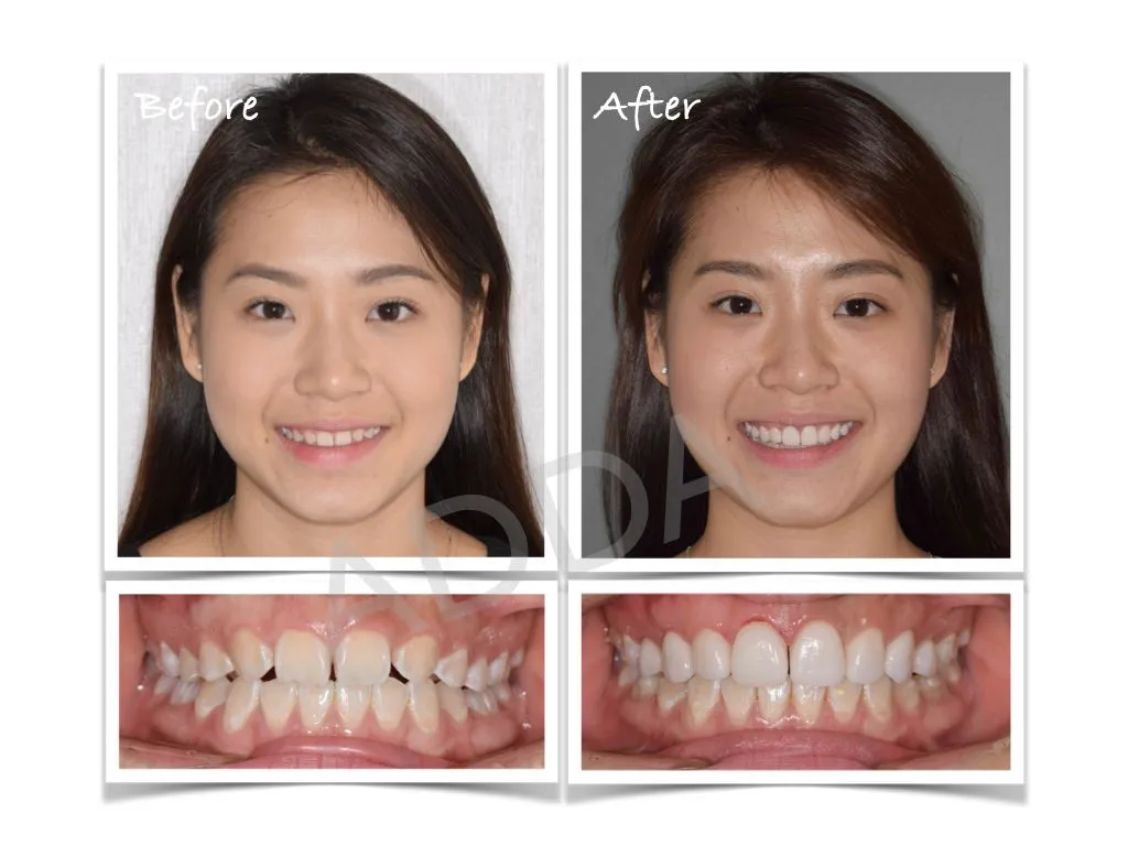 Smile Makeover Case Study 10: Porcelain Veneers