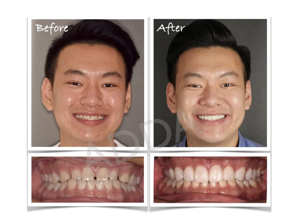 Smile Makeover Case Study 11: Porcelain Veneers