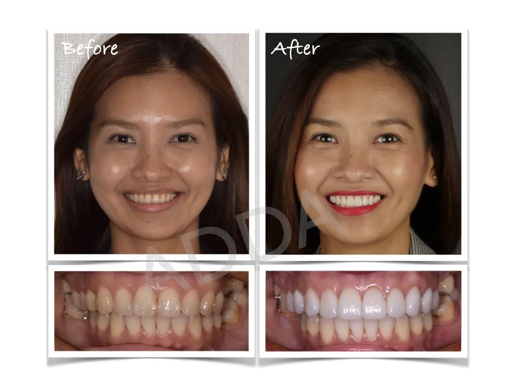 Smile Makeover Case Study 12: Porcelain Veneers