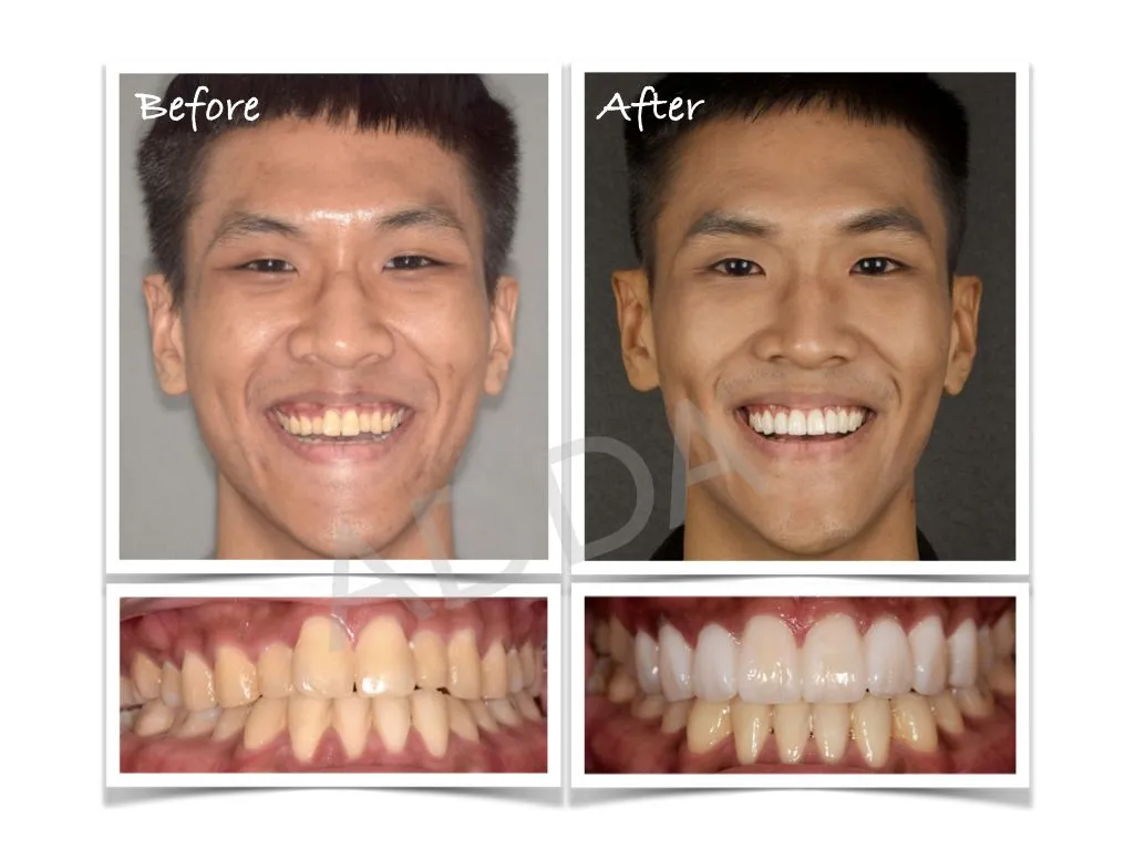 Smile Makeover Case Study 13: Porcelain Veneers