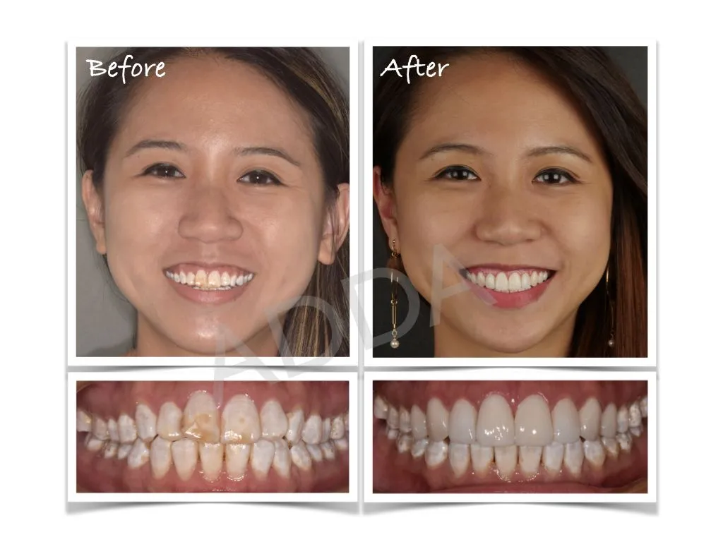 Smile Makeover Case Study 15: Invisalign & Porcelain Veneers