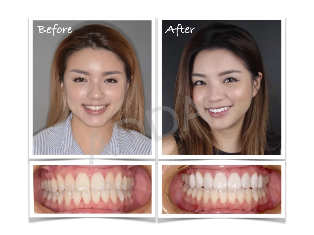 Smile Makeover Case Study 16: Porcelain Veneers