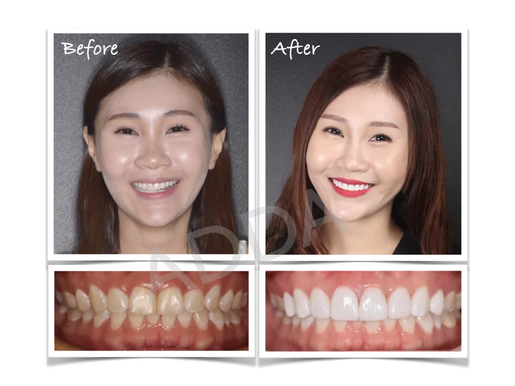 Smile Makeover Case Study 17: Porcelain Veneers