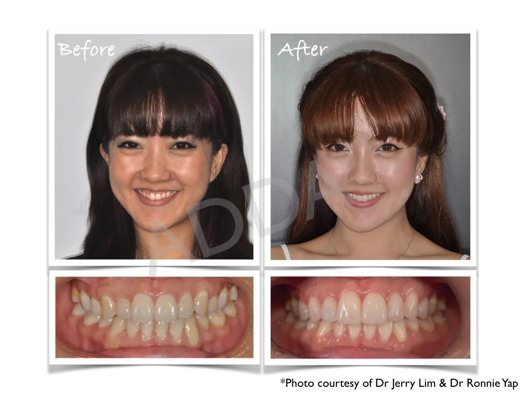 Smile Makeover Case Study 2: Porcelain Veneers