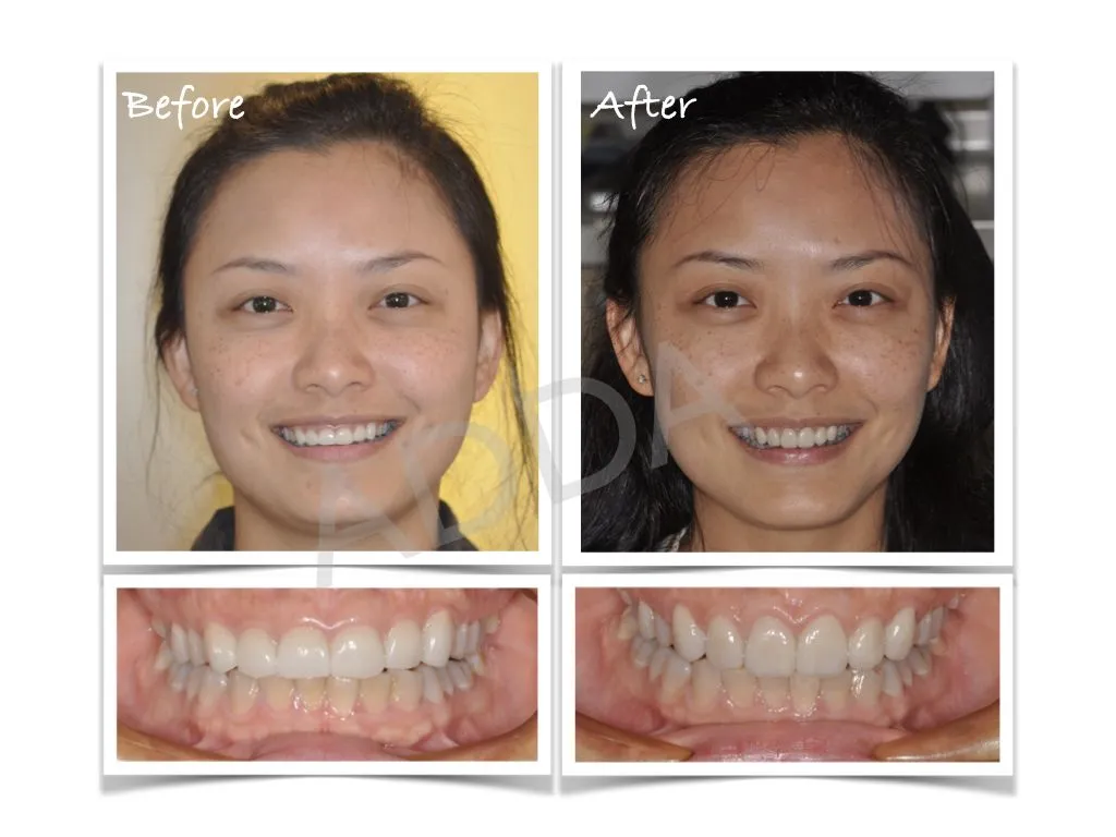 Smile Makeover Case Study 3: Porcelain Veneers