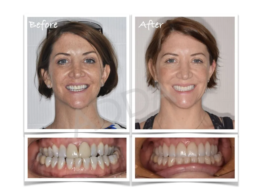 Smile Makeover Case Study 4: Porcelain Veneers