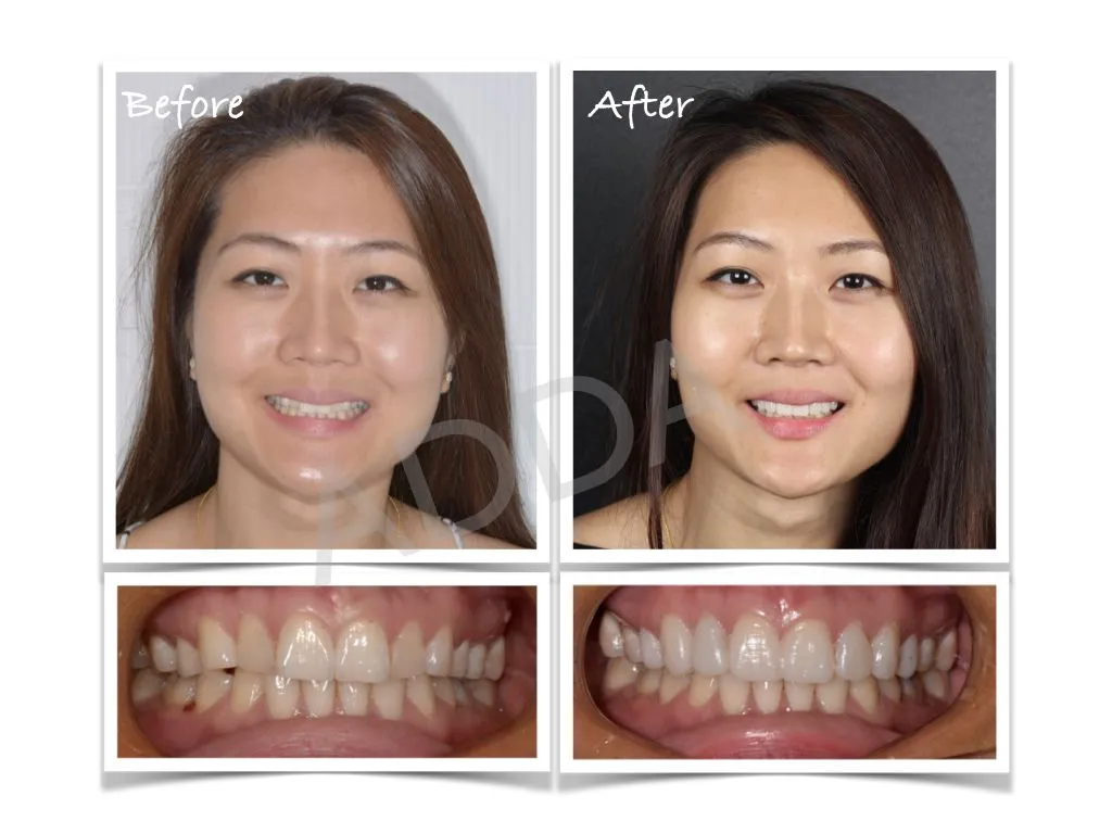 Smile Makeover Case Study 5: Porcelain Veneers