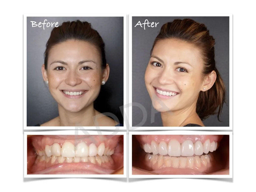 Smile Makeover Case Study 6: Porcelain Veneers