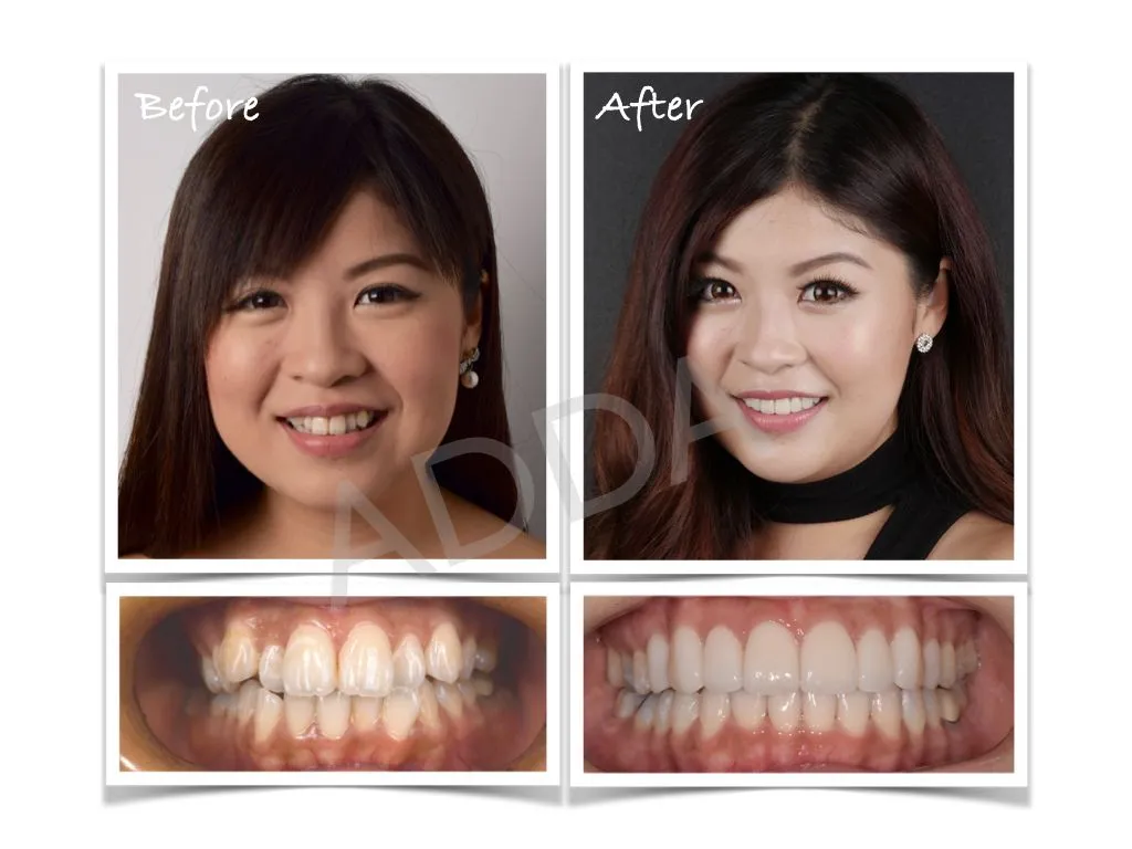 Smile Makeover Case Study 7: Porcelain Veneers