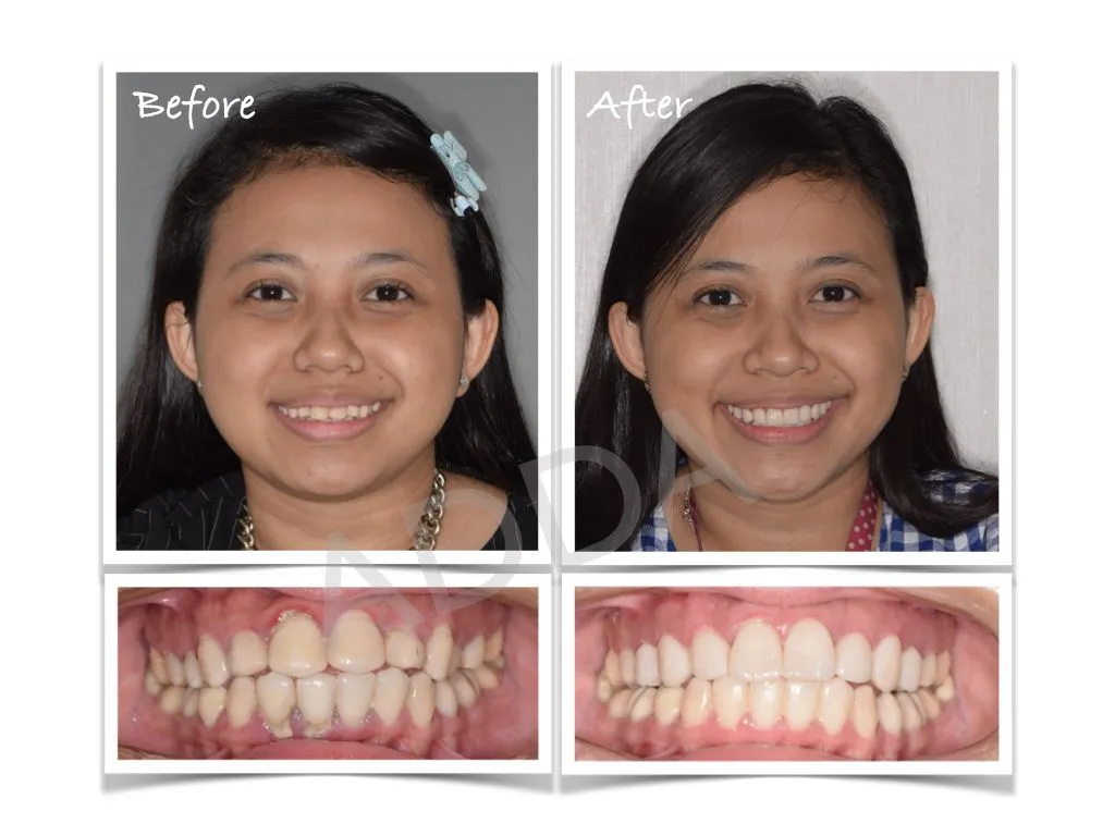 Smile Makeover Case Study 8: Porcelain Veneers