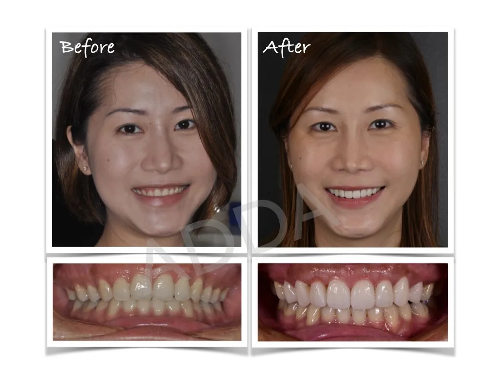 Smile Makeover Case Study 9: Porcelain Veneers