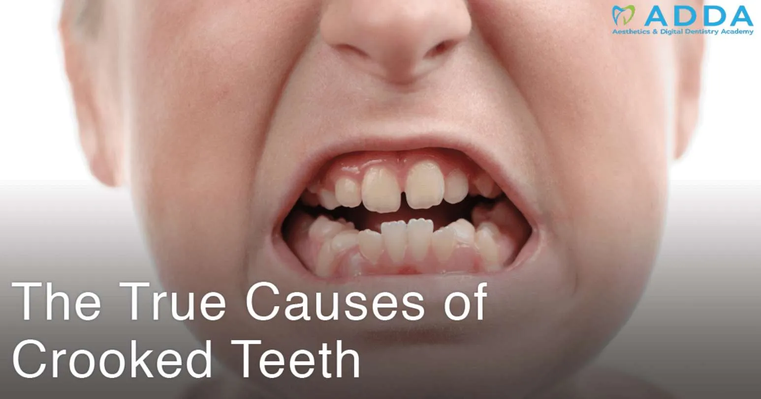 The True Causes of Crooked Teeth