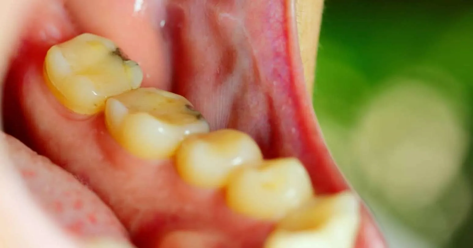 Understanding Choice of Materials in Mercury-Free Dentistry