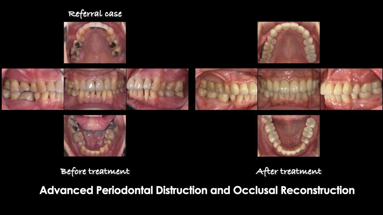 Advanced periodontal destruction and occlusal reconstruction — before and after treatment