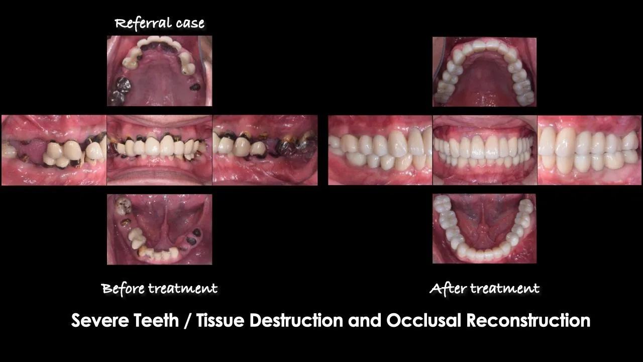 Severe teeth and tissue destruction — full mouth reconstruction