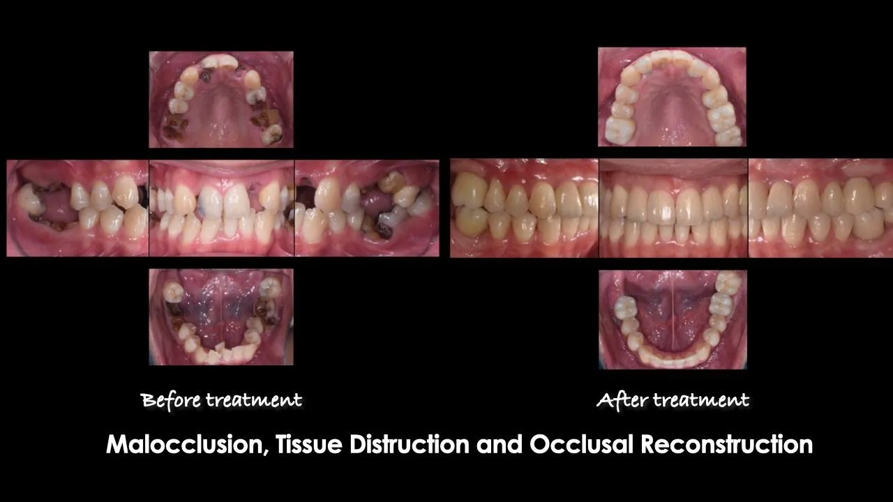 Malocclusion and tissue destruction — before and after occlusal reconstruction