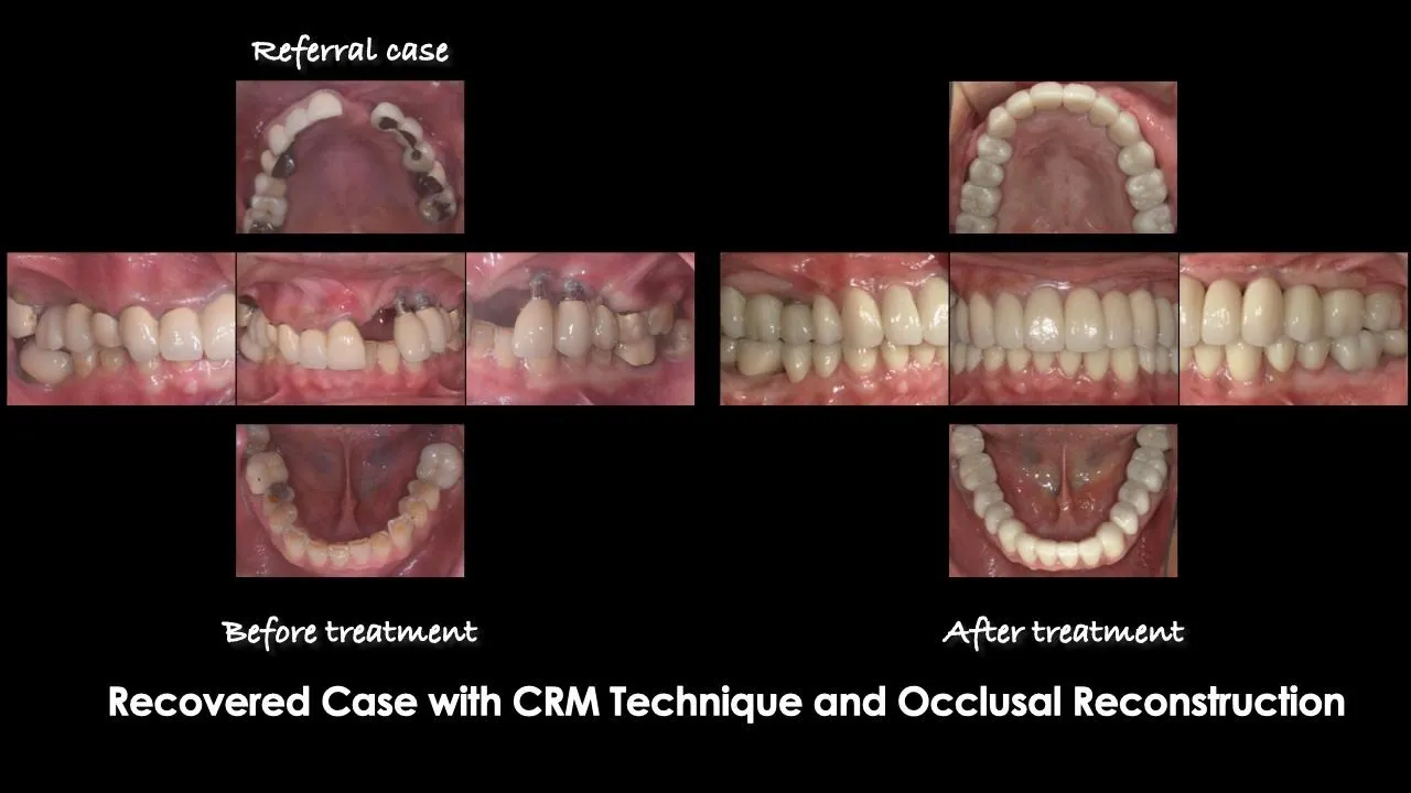 Recovered case with CRM Technique — Before and after treatment showing full occlusal reconstruction
