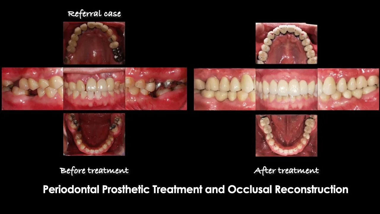 Periodontal prosthetic treatment and occlusal reconstruction — before and after