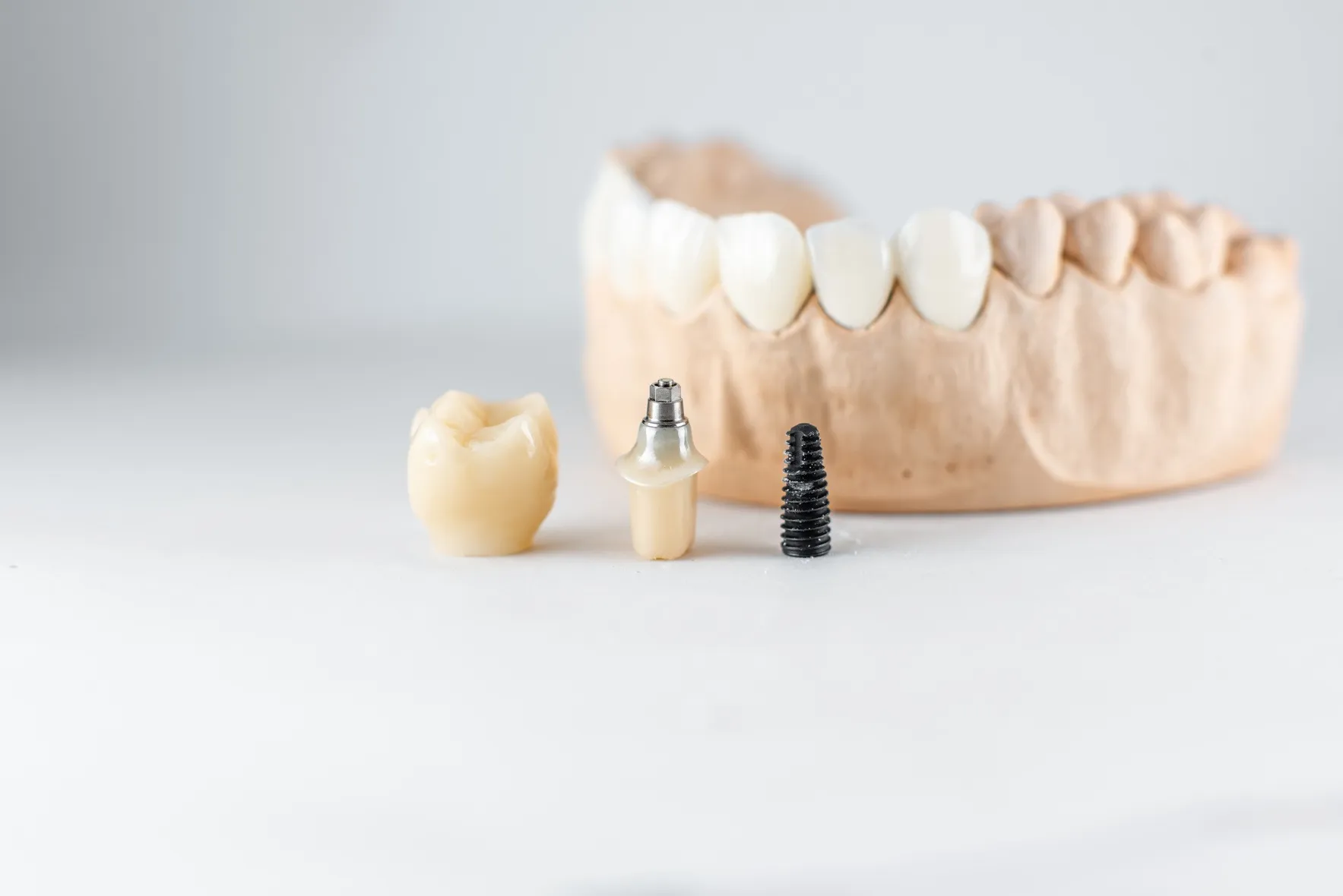 N.E.W (Natural Emulate Workflow) Hard and Soft Tissue Management in Implant Dentistry — Series 2