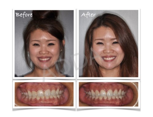 Laser Gum Reshaping Case Study 1