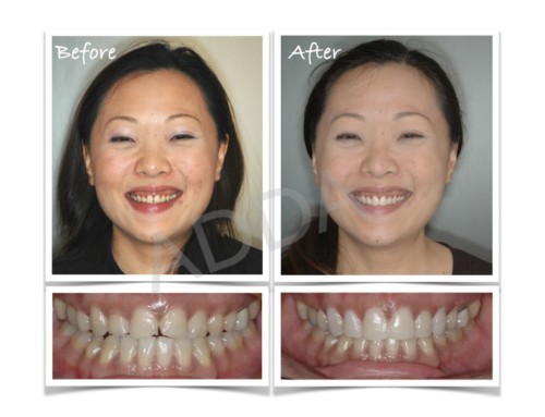 Laser Gum Reshaping Case Study 4