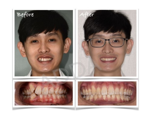 Invisalign Before and After Case Study 9