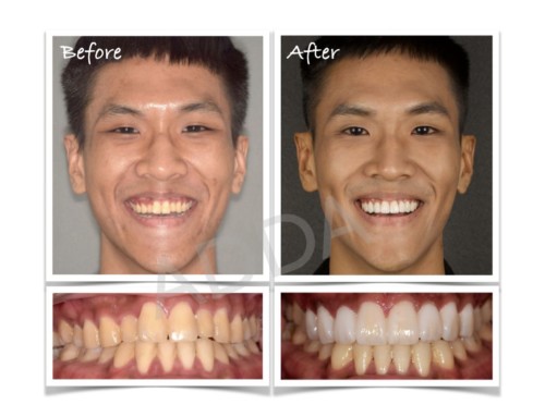 Smile Makeover Case Study 13: Invisalign and Porcelain Veneers