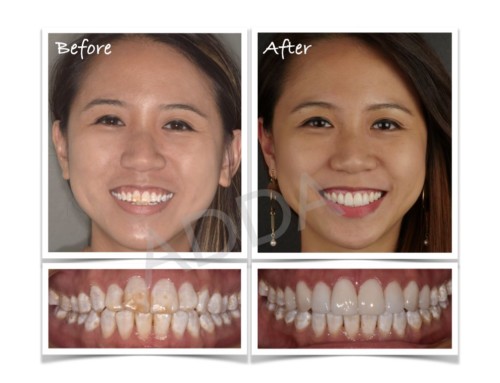 Smile Makeover Case Study 15: Invisalign & Porcelain Veneers