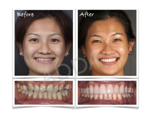 Smile Makeover Case Study 14: Invisalign,  Laser Gum Recontouring, Porcelain Veneers