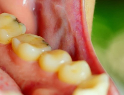 Understanding Choice of Materials in Mercury-Free Dentistry